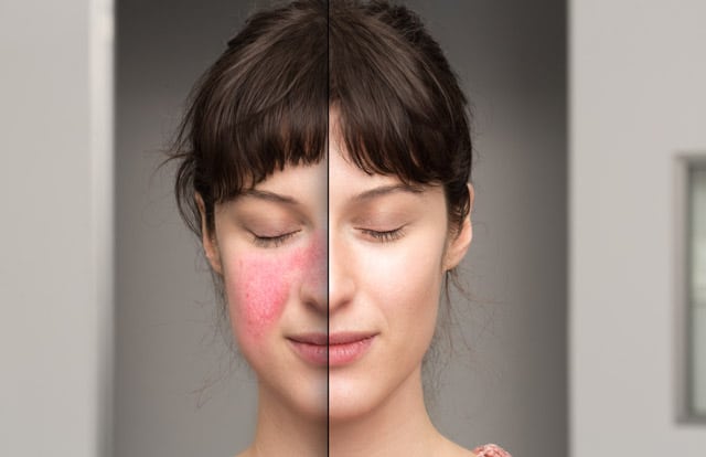 Rosacea Treatment